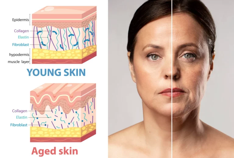 Split image of a woman's face showing youthful versus aged skin, alongside diagrams of young and old skin layers (dermis and SMAS).